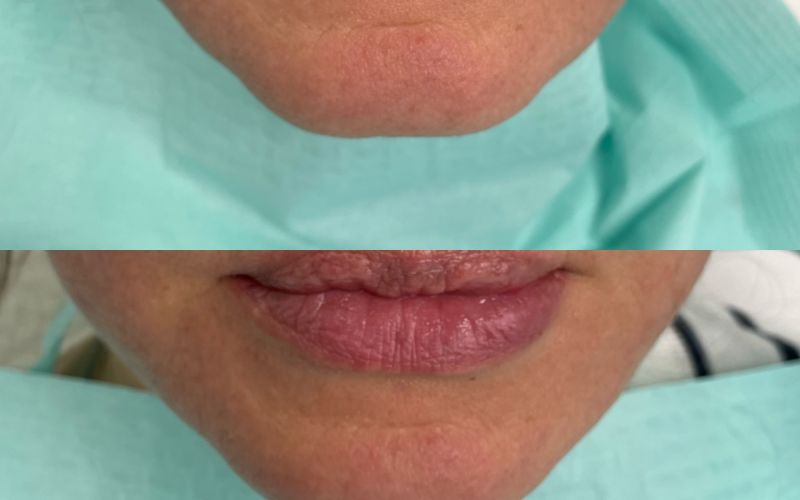 modelowanie brody kwasem hialuronowym