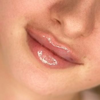 Modelowanie ust- 10 najczęstszych pytań przed pierwszym zabiegiem