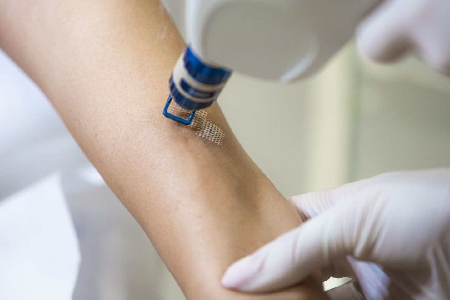 laserowe usuwanie blizn