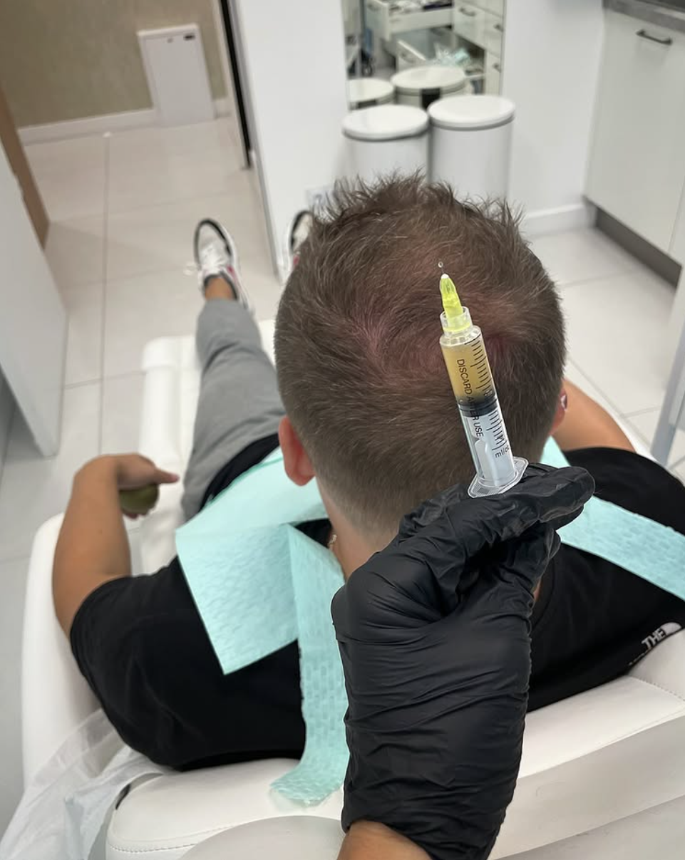 Ablauf der Behandlung mit plättchenreichem Plasma in Wrocław - Injektion des Präparats in die Gesichtshaut