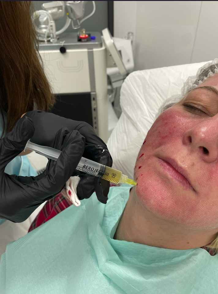 Plättchenreiches Plasma für das Gesicht - Injektion des PRP-Präparats, MM Clinic Wrocław